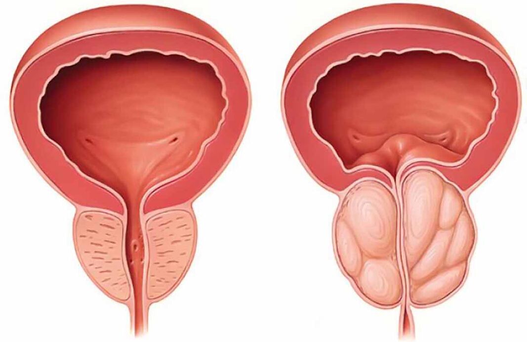 Normalna prostata i upala prostate (kronični prostatitis)