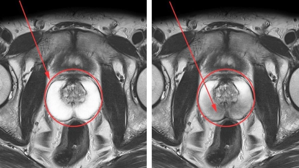Ultrazvuk za kronični prostatitis – zdrava prostata (lijevo) i upaljena (desno)