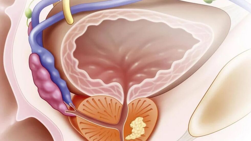 Nebakterijski kronični prostatitis