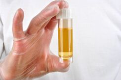Analiza urina jedna je od metoda za dijagnosticiranje prostatitisa