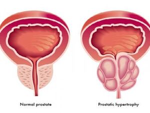 Normalna i upaljena prostata
