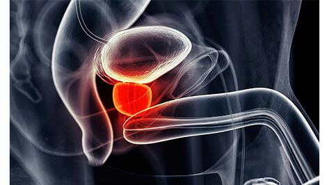 upala prostate